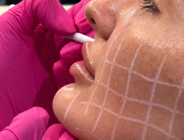 Skinvive treatment being performed