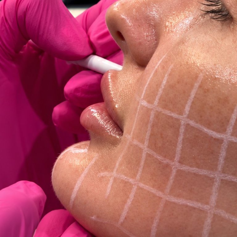 Skinvive treatment being performed